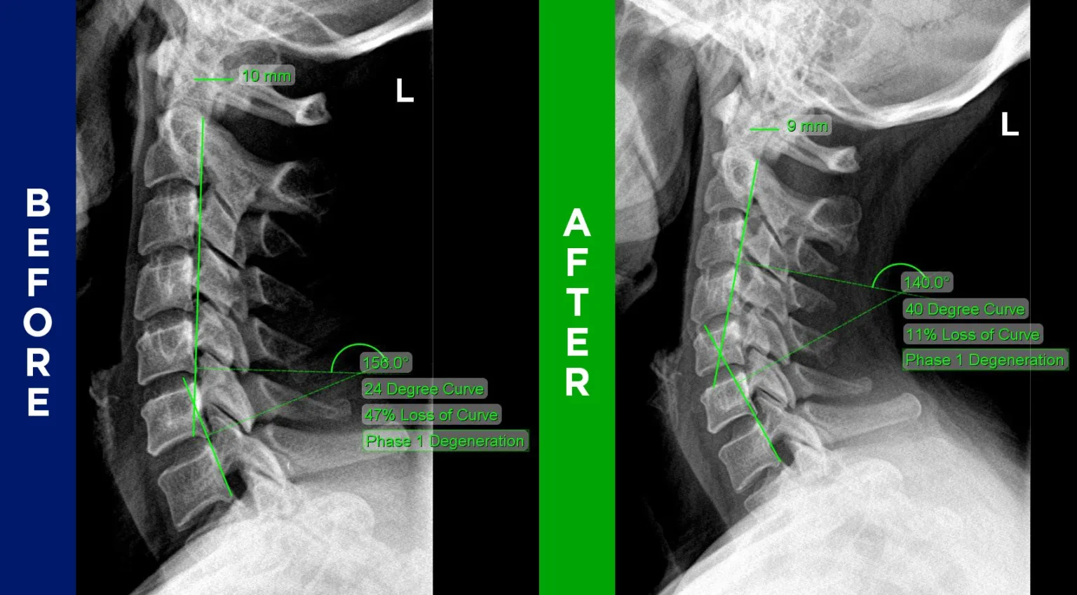 Neck Pain Before & After